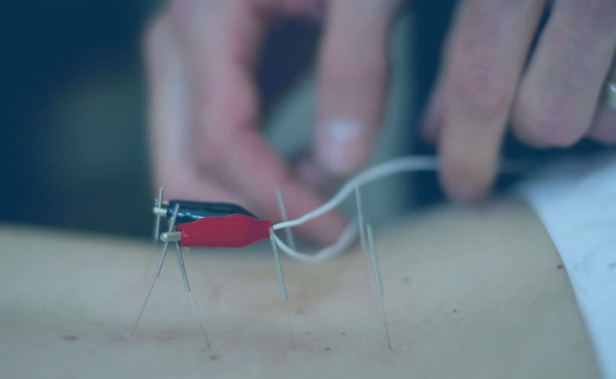 acupuncturebanner2 Riverside Chiropractic