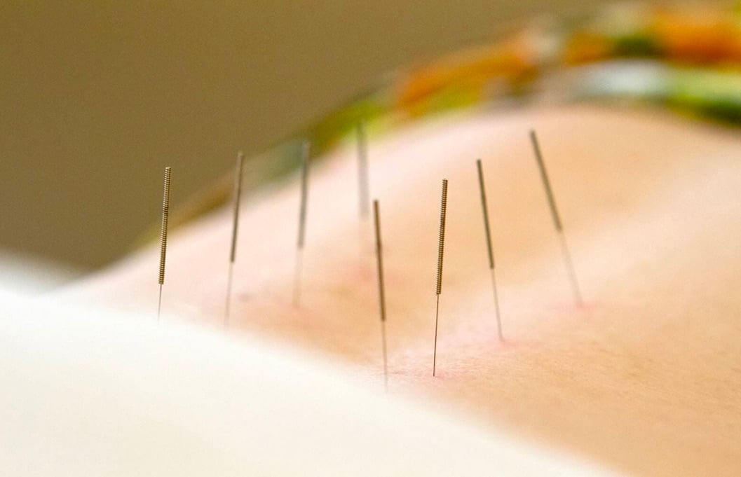 medical-acupuncture-image
