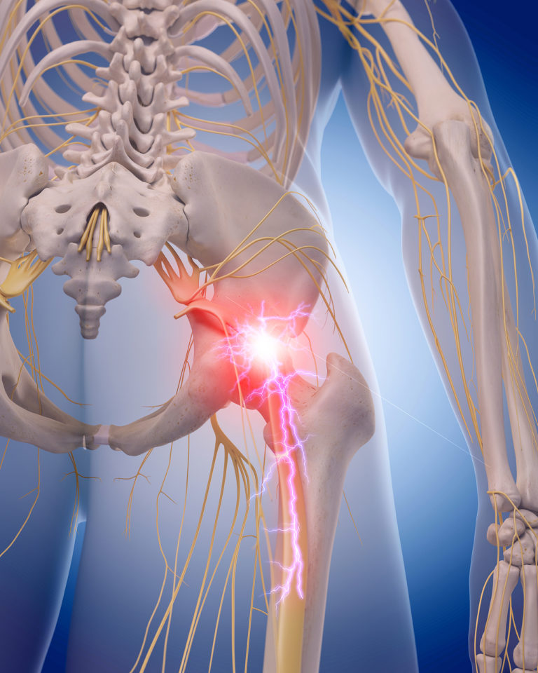 sciatica pain relief